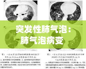 突發性肺氣泡：肺氣泡病變 